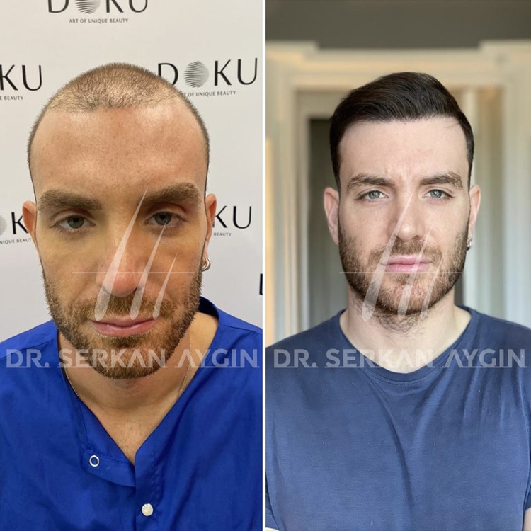 Haartransplantation Türkei Testsieger Ergebnis