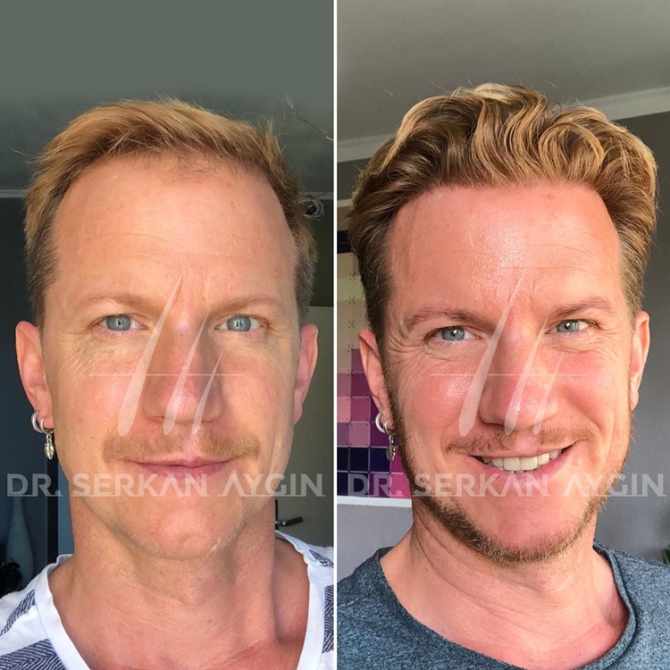 haartransplantation türkei vorher nachher ergebnis